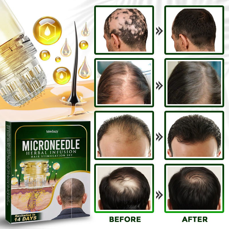 👱♂️ Medazy® Microneedle Herbal Infusion Hair Stimulation Set 🇺🇸 Recommended by