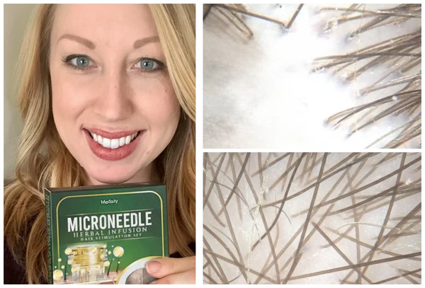 👱♂️ Medazy® Microneedle Herbal Infusion Hair Stimulation Set 🇺🇸 Recommended by