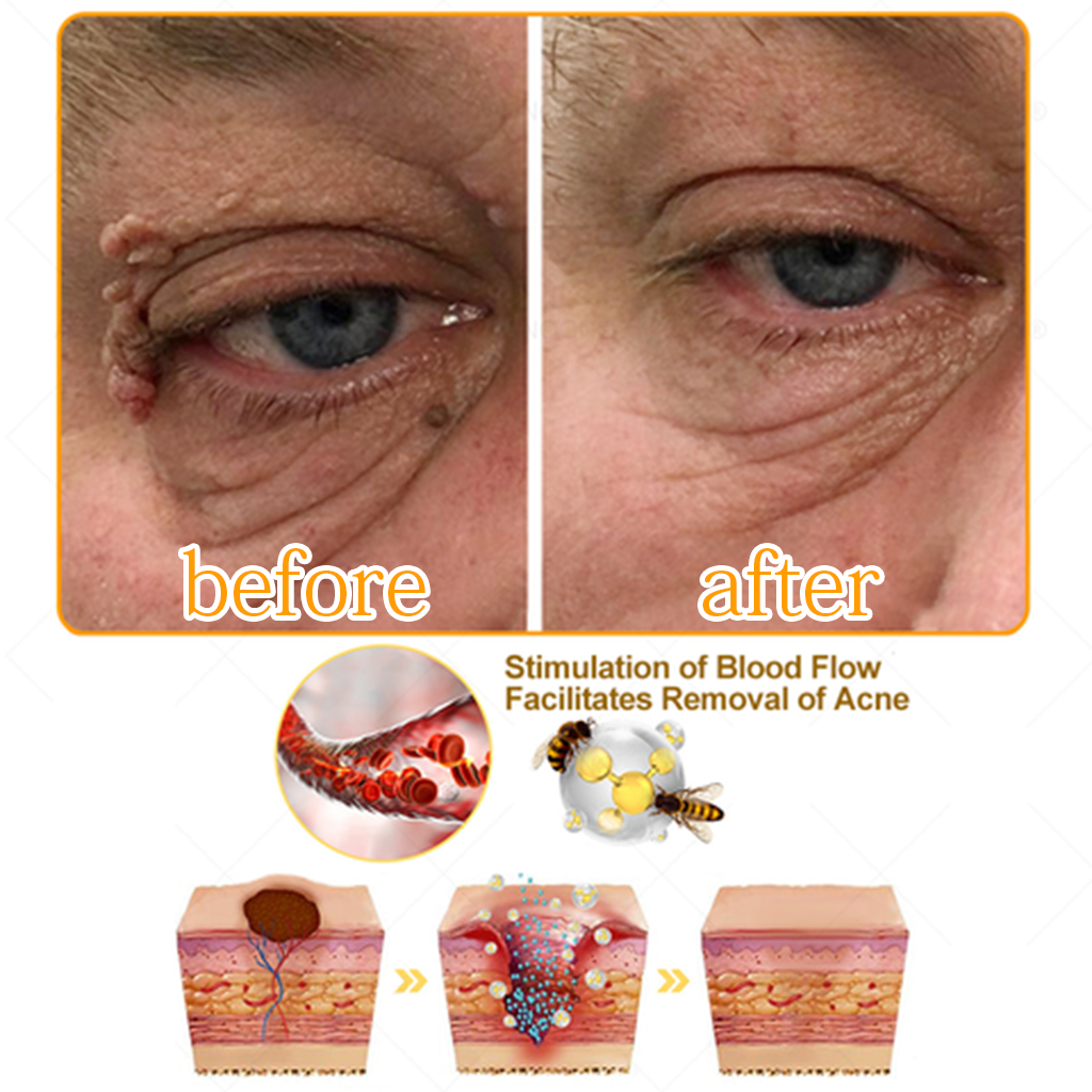 ✅ Official store: 🔥🐝Medazy™TagRecede Bee Spray ✨👨‍⚕️ Approved by the American Association of Dermatology (AAOS)