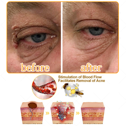 ✅ Official store: 🔥🐝Medazy™TagRecede Bee Spray ✨👨‍⚕️ Approved by the American Association of Dermatology (AAOS)