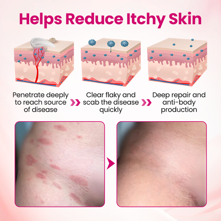 HPV negative conversion power MAX! LOVILDS™ interferon gel: Targeting high-risk viruses and repairing the cervix in one step