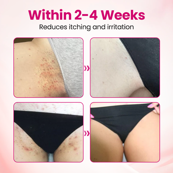 HPV negative conversion power MAX! LOVILDS™ interferon gel: Targeting high-risk viruses and repairing the cervix in one step