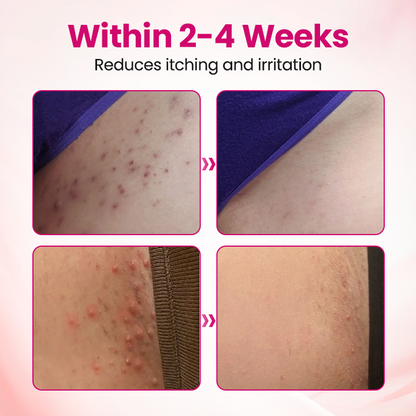 HPV negative conversion power MAX! LOVILDS™ interferon gel: Targeting high-risk viruses and repairing the cervix in one step